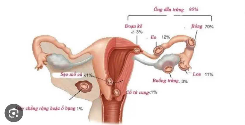 Các dấu hiệu chứng tỏ bạn đã mang thai ngoài tử cung . Thuốc Phá Thai Tại Nhà .