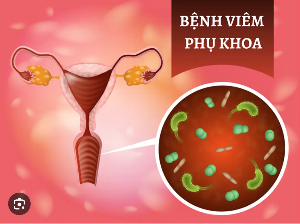 Viêm Phụ Khoa Và Cách Chữa Viêm Phụ Khoa .Thuốc Phá Thai Tại Nhà .