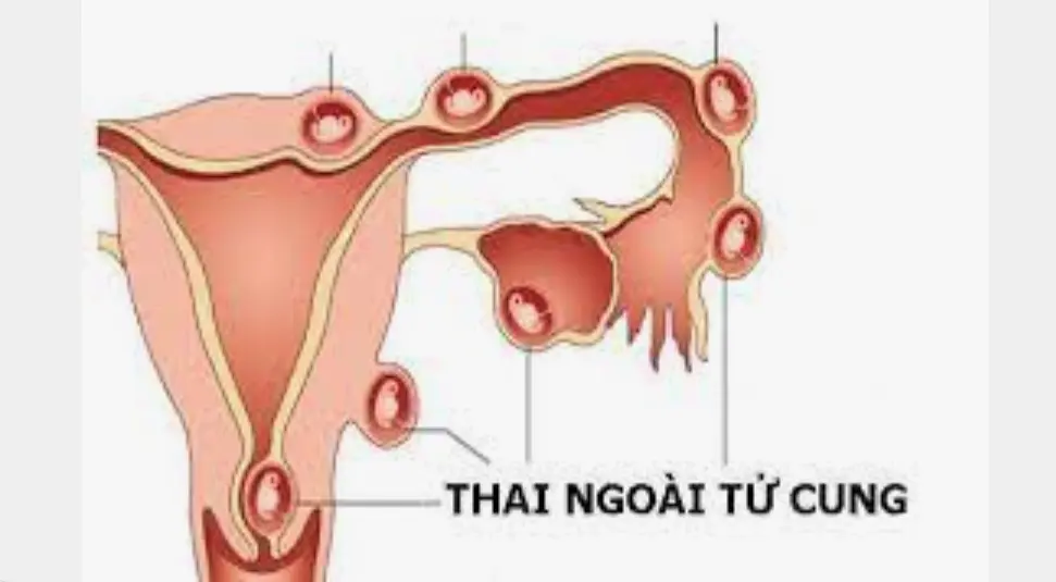 Thai ngoài tử cung là gì ? Thuốc Phá Thai Tại Philippines .