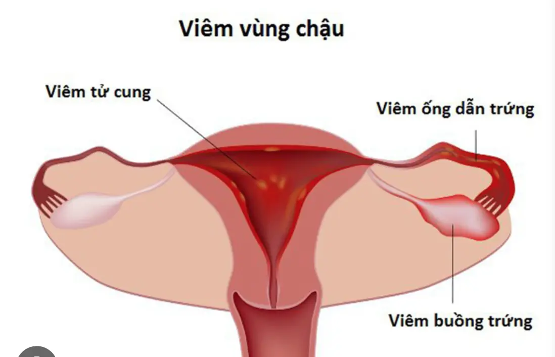 Cách chữa niêm mạc tử cung dày giúp tăng khả năng thụ thai . Thuốc Phá Thai Tại Philippine .