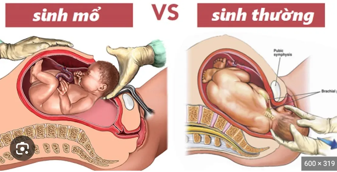 Ưu điểm của sinh thường và sinh mổ như nào ? Thuốc Phá Thai Tại Autralia .