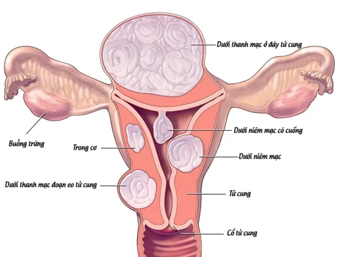 U xơ tử cung nguyên nhân là gì ? các phương pháp điều trị u xơ tử cung .Thuốc Phá Thai Tại Singapore .