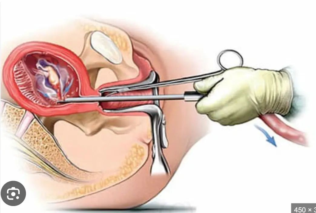 Viêm nhiễm phụ khoa: Nguyên nhân, dấu hiệu, điều trị và cách phòng tránh . Thuốc Phá Thai Tại Philippines .