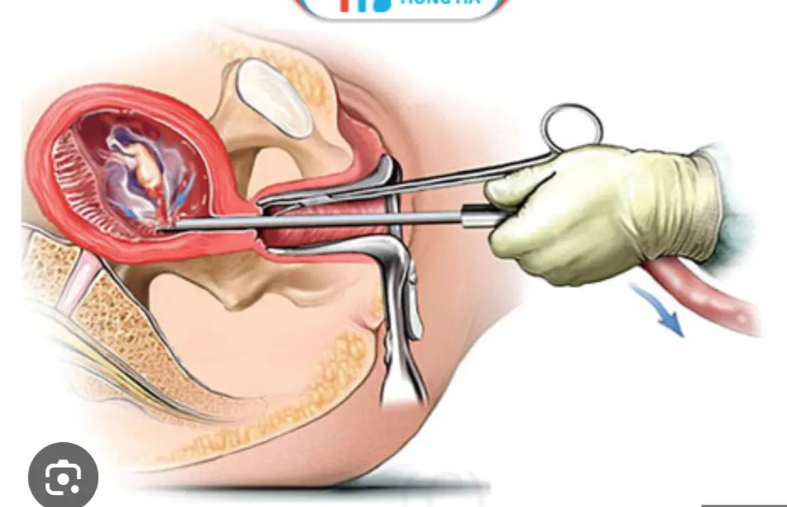 Cách chăm sóc sức khỏe sau nạo thai để nhanh hồi phục . Thuốc Phá Thai Tại Singapore .